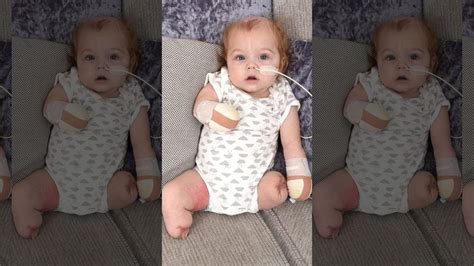 Baby loses all 4 limbs following sepsis infection, mom claims one leg 'came off in her hand'