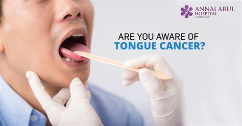 Are You Aware Of Tongue Cancer Multispeciality Hospitals In Chennai