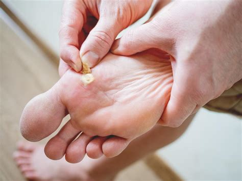 How To Get Rid Of Warts On The Soles Of Your Feet Town Center Foot