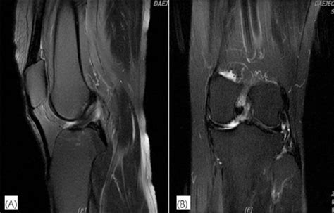Mri Of Left Knee T2 A Sagittal View B Coronal View Download