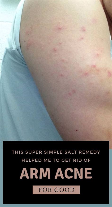 This Super Simple Salt Remedy Helped Me To Get Rid Of Arm Acne For Good