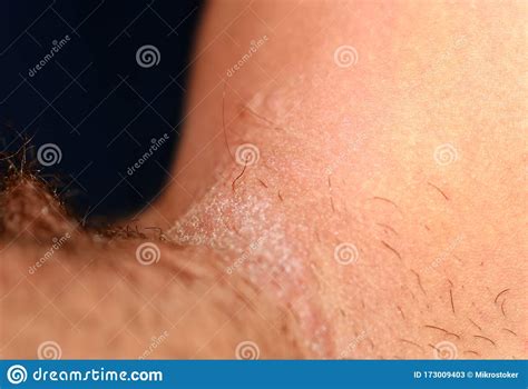 Fungal Infection In The Groin Psoriasis Dermatitis Eczema Stock