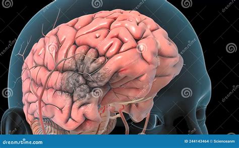 Hemorragia Cerebral Como Resultado De Um Aneurisma Que Rebenta No