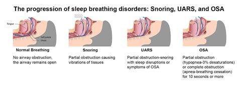 UARS Upper Airway Resistance Syndrome My Sleep Device