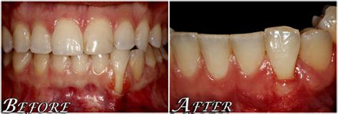 Receding Gums Also Known As Gum Grafting By The Center 4 Smiles