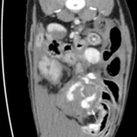 Ct Transverse Postcontrast Image Of The Abdomen Note The Rounded