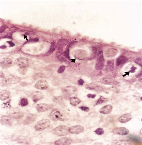 A Photomicrograph Of Human Endometrium Of Rpl Group Showing That Some