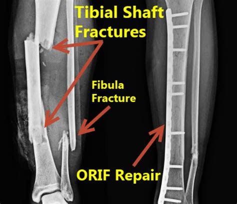 Broken Tibia Tibial Shaft Fracture Diagnosis Treatmen