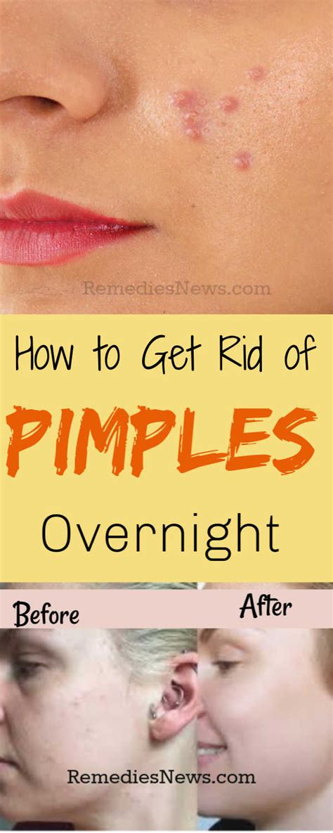 11 Effective Home Remedies To Get Rid Of Pimples Overnight
