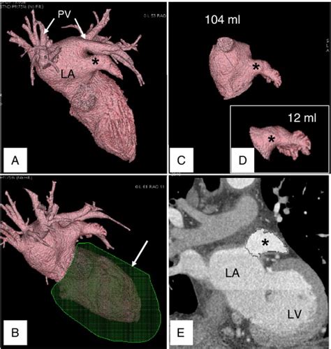 Real Three Dimensional Assessment Of Left Atrial And Left Atrial