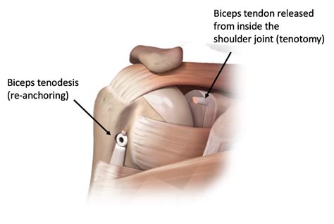 Rotator Cuff Repair Shoulder Surgery Sydney Shoulder Unit