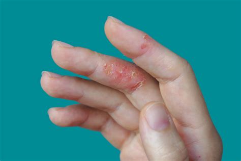 Understanding Eczema On Hands Causes Treatments And Prevention Hub