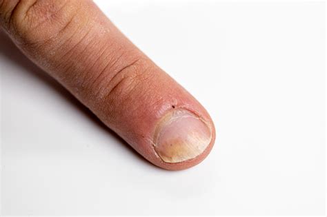 Fingers With Psoriatic Onychodystrophy Or Psoriatic Nails Psoriasis