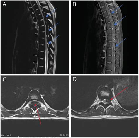 Mri Spine Intraspinal Epidural Extramedullary Masses T2 Lowered
