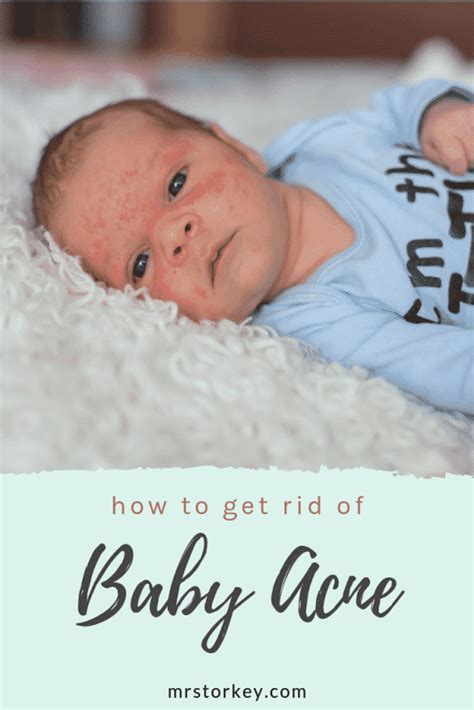 How To Get Rid Of Baby Acne