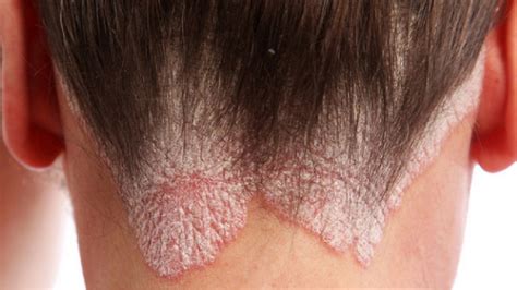 Alopecia Psorisiaca Cosa Si Deve Sapere Cause E Rimedi Insalaco Clinic