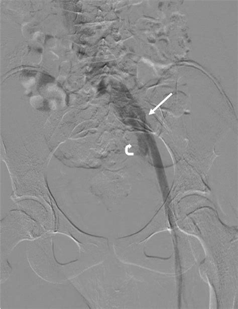 Figure 4 From May Thurner Syndrome With Inferior Mesenteric Vein