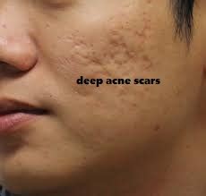 About three to six months. How Long Acne Scar Keep Stay in Your Skin? - Acne Advices