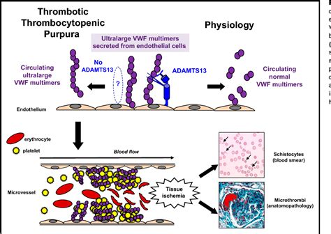 Pdf Thrombotic Thrombocytopenic Purpura Semantic Scholar