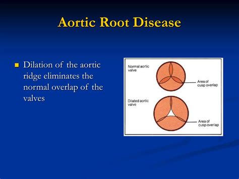 Ppt Aortic Regurgitation Powerpoint Presentation Free Download Id