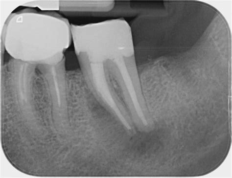 Root Canal Treatment Gallery Before And After Photos London Dentist
