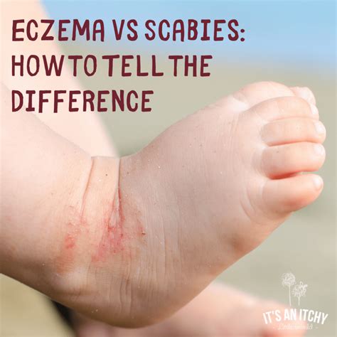 Whats The Difference Between Eczema Vs Scabies Its An Itchy