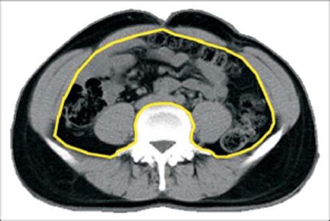 Scielo Brasil Reproducibility Of Abdominal Fat Assessment By