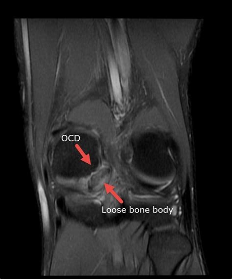 Osteochondritis Dissecans Of The Medial Femoral Condyle With Full
