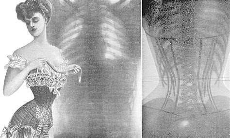 From Squashed Ribs To Displaced Spleens Vintage X Rays Reveal The