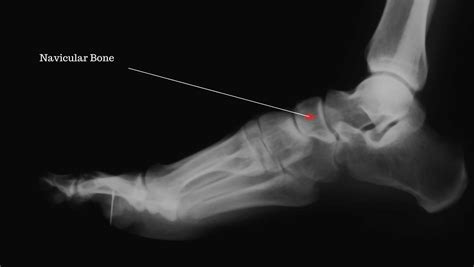 Navicular Stress Fracture Learn How To Treat By A Foot Specialist