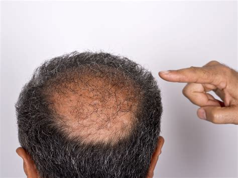 The Bald Spots That Are Linked To Cancer Easy Health Options®