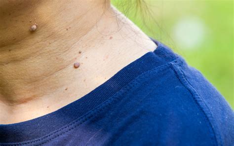 Signs You Should Have A Mole Checked The Bowman Institute