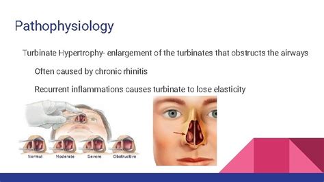 Turbinectomy By Carly Winegar Anatomy Nasal Turbinates Nasal