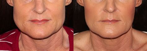 Masseter Muscle Botox Before And After