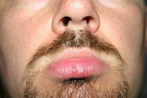 Your feet propel you forward. How to Prevent Fever Blisters and Cold Sores | HealDove