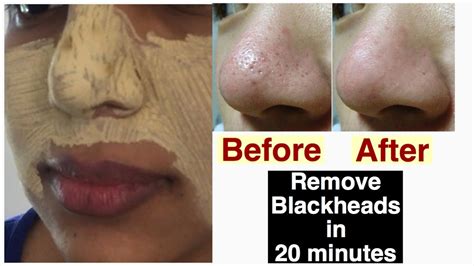 How To Close Open Pores And Remove Blackheads And Whiteheads Live