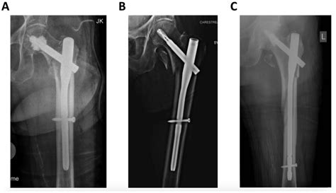 Jcm Free Full Text Inferior Outcome After Unstable Trochanteric