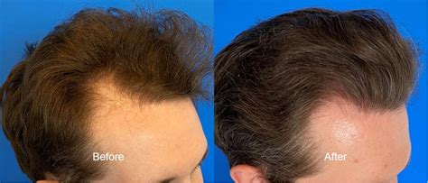 Hairline Restoration With Fut Donor Strip Harvest Hair Restoration