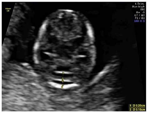 Axial View Of The Fetal Posterior Fossa With Measurements Of The Cm