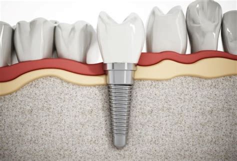 What Are Dental Implants A Basic Guide Tunexp