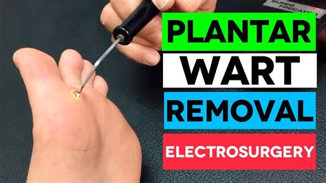 Fast Plantar Wart Removal By Electrosurgery Youtube