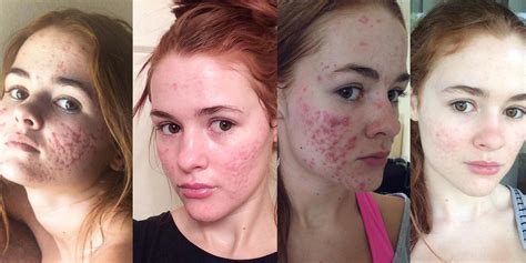 This Womans Before And After Acne Pictures Are Going Viral For Good