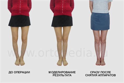 operative correction of bow legs is only effective method to fix bowlegs in adults bow legged