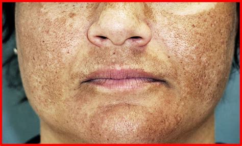 Melasma O Que é Causas E Tratamentos Cura Natural