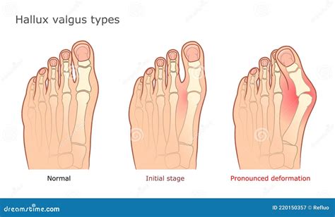 Hallux Valgus Is The Commonest Forefoot Deformity Stock Image