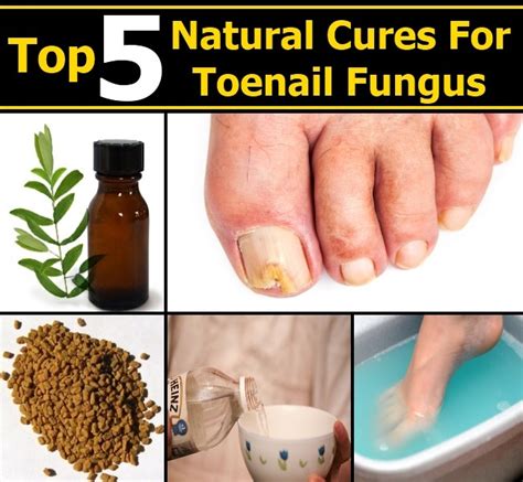 Top 5 Natural Cures For Toenail Fungus Diy Home Remedies Kitchen