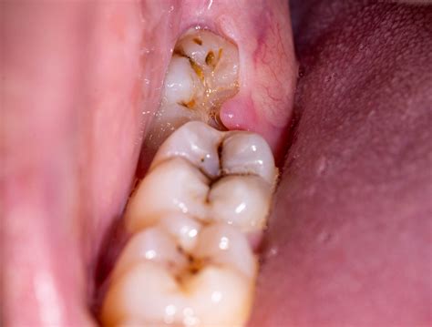 Wisdom Teeth Causes The 5 Symptoms And Best Treatment