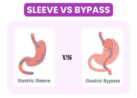 Gastric Bypass Vs Gastric Sleeve Which One Is Better For You