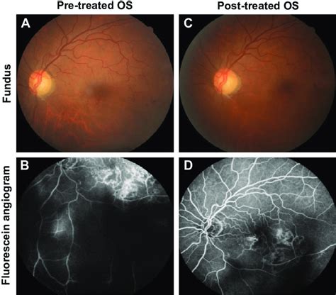 Represents The Color Fundus Photo And Fundus Fluorescein Angiography Of