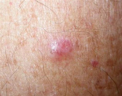 Skin Cancer Lump On Back